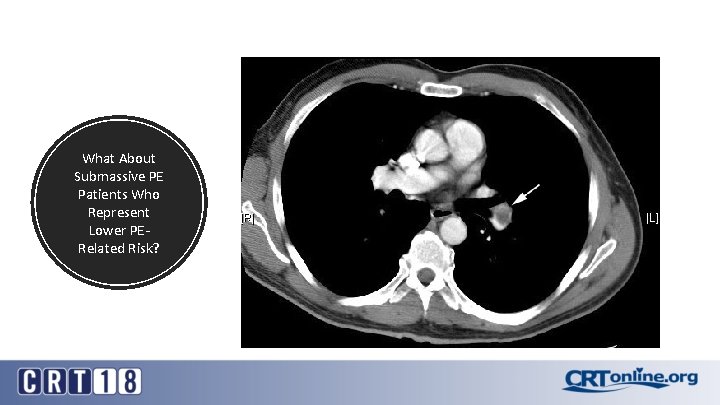 What About Submassive PE Patients Who Represent Lower PERelated Risk? 