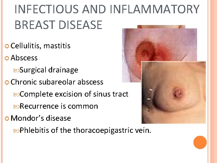 INFECTIOUS AND INFLAMMATORY BREAST DISEASE Cellulitis, mastitis Abscess Surgical drainage Chronic subareolar abscess Complete