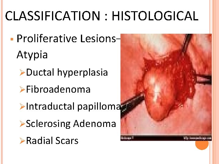 CLASSIFICATION : HISTOLOGICAL § Proliferative Lesions– Without Atypia ØDuctal hyperplasia ØFibroadenoma ØIntraductal papilloma ØSclerosing