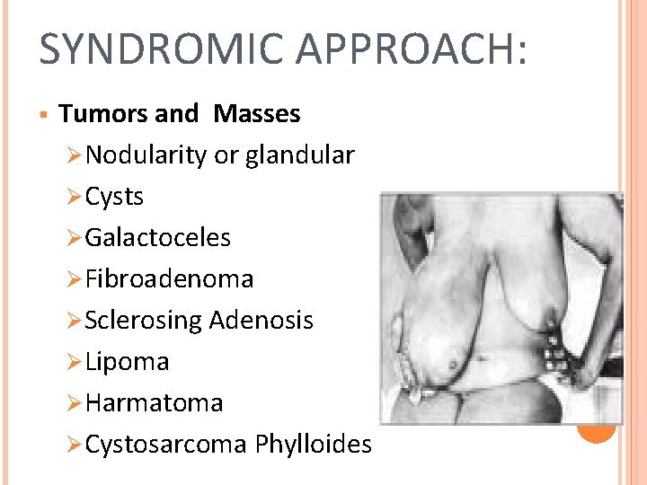 SYNDROMIC APPROACH: § Tumors and Masses ØNodularity or glandular ØCysts ØGalactoceles ØFibroadenoma ØSclerosing Adenosis