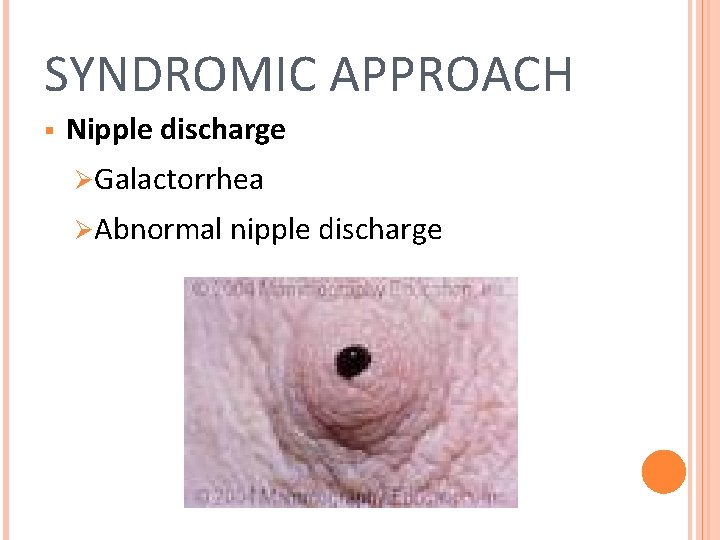SYNDROMIC APPROACH § Nipple discharge ØGalactorrhea ØAbnormal nipple discharge 