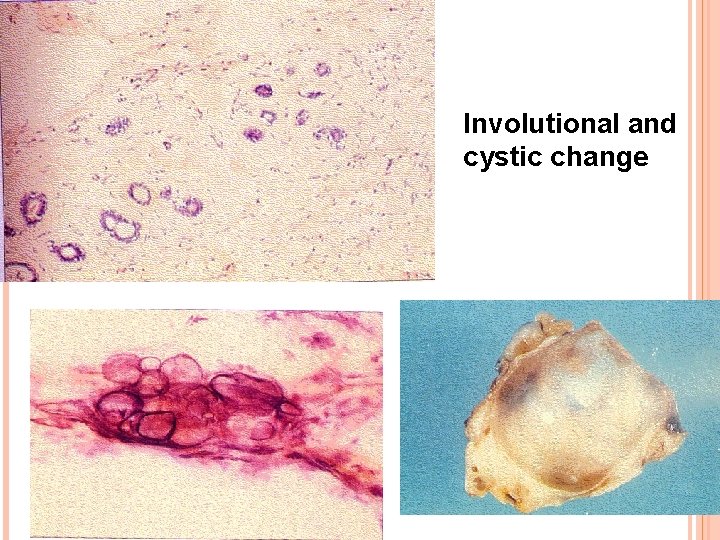 Involutional and cystic change 