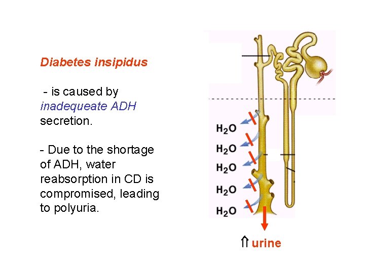 Diabetes insipidus - is caused by inadequeate ADH secretion. - Due to the shortage Diabetes insipidus - is caused by inadequeate ADH secretion. - Due to the shortage