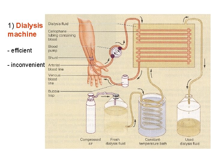 1) Dialysis machine - efficient - inconvenient 1) Dialysis machine - efficient - inconvenient