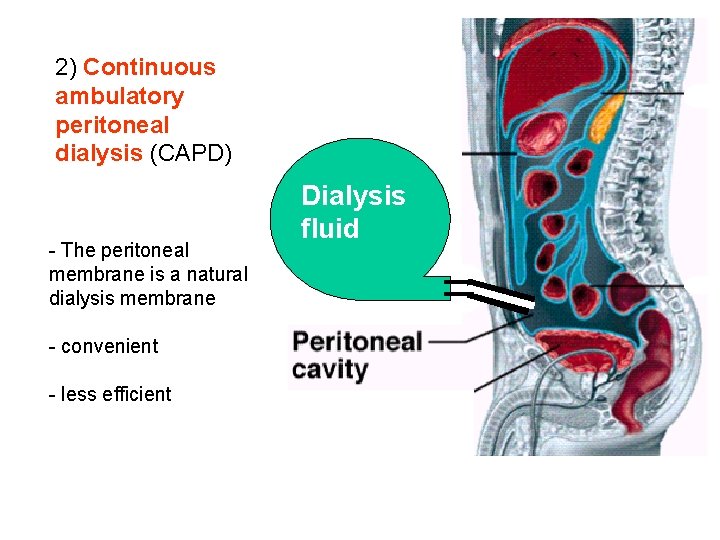 2) Continuous ambulatory peritoneal dialysis (CAPD) - The peritoneal membrane is a natural dialysis 2) Continuous ambulatory peritoneal dialysis (CAPD) - The peritoneal membrane is a natural dialysis