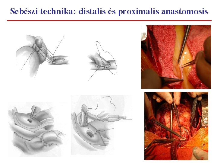 Sebészi technika: distalis és proximalis anastomosis 