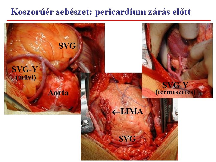Koszorúér sebészet: pericardium zárás előtt SVG-Y (művi) SVG-Y (természetes) Aorta LIMA SVG 