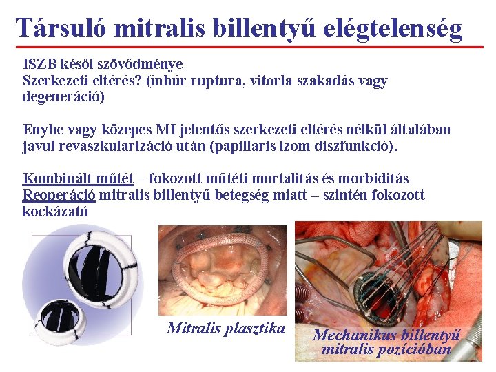 Társuló mitralis billentyű elégtelenség ISZB késői szövődménye Szerkezeti eltérés? (ínhúr ruptura, vitorla szakadás vagy