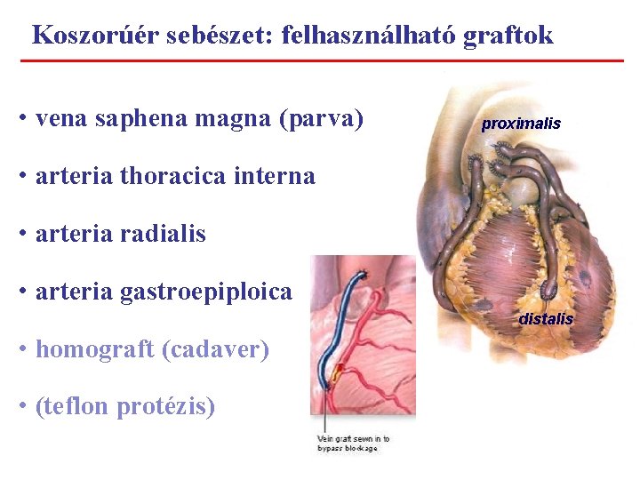 Koszorúér sebészet: felhasználható graftok • vena saphena magna (parva) proximalis • arteria thoracica interna