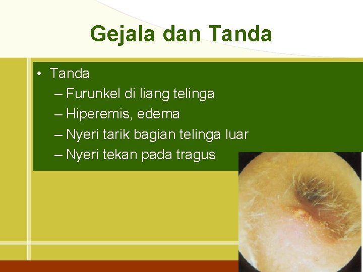 Gejala dan Tanda • Tanda – Furunkel di liang telinga – Hiperemis, edema –