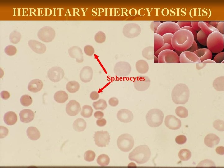 HEREDITARY SPHEROCYTOSIS (HS) Spherocytes 