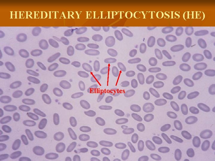 HEREDITARY ELLIPTOCYTOSIS (HE) Elliptocytes 