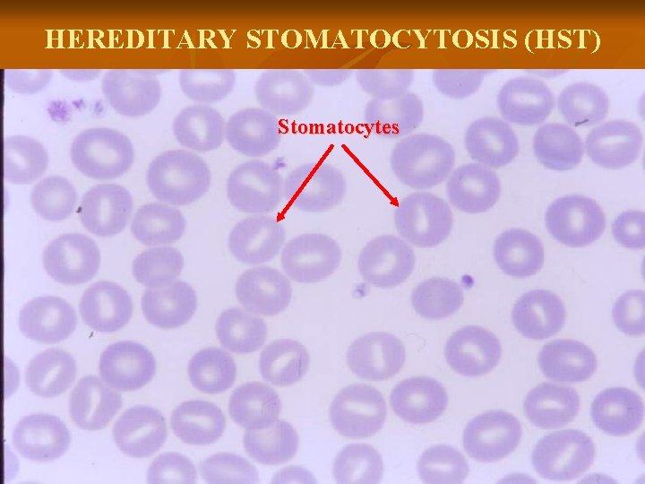 HEREDITARY STOMATOCYTOSIS (HST) Stomatocytes 