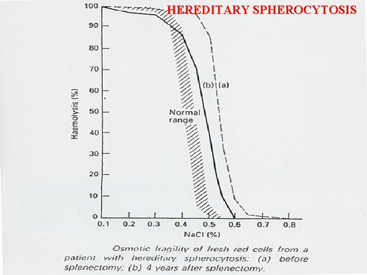 HEREDITARY SPHEROCYTOSIS 