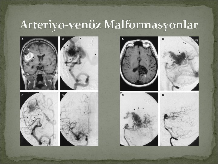 Arteriyo-venöz Malformasyonlar 