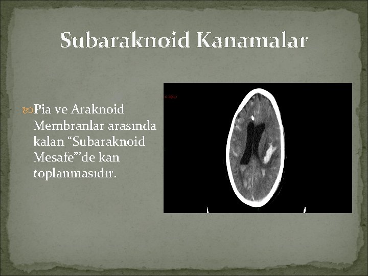 Subaraknoid Kanamalar Pia ve Araknoid Membranlar arasında kalan “Subaraknoid Mesafe”’de kan toplanmasıdır. 