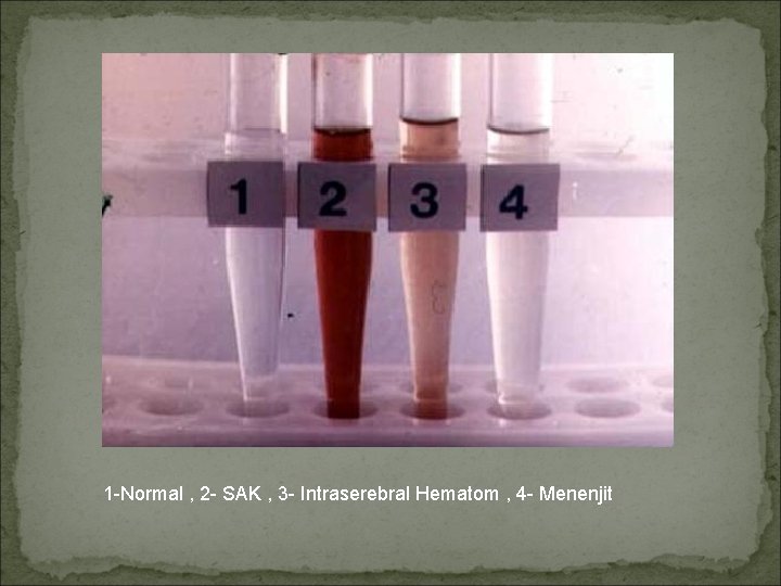 1 -Normal , 2 - SAK , 3 - Intraserebral Hematom , 4 -