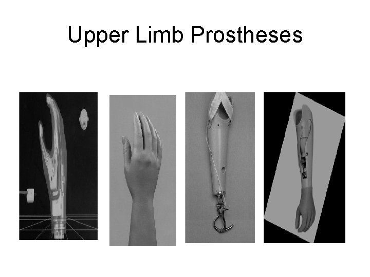 Upper Limb Prostheses 