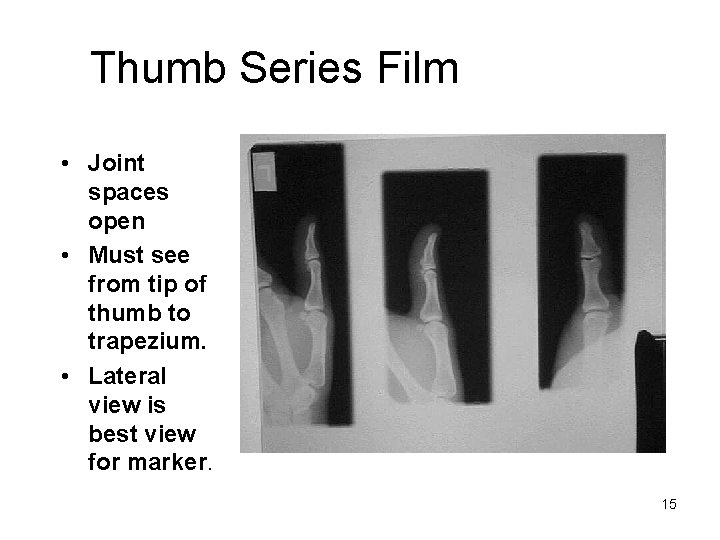 Thumb Series Film • Joint spaces open • Must see from tip of thumb