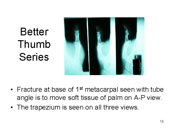 Better Thumb Series • Fracture at base of 1 st metacarpal seen with tube