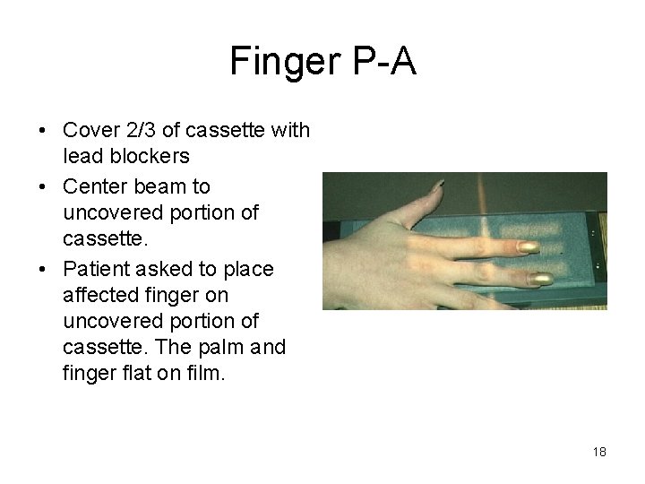 Finger P-A • Cover 2/3 of cassette with lead blockers • Center beam to