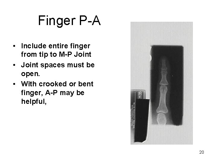 Finger P-A • Include entire finger from tip to M-P Joint • Joint spaces