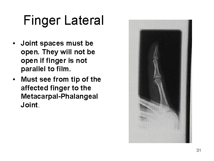 Finger Lateral • Joint spaces must be open. They will not be open if