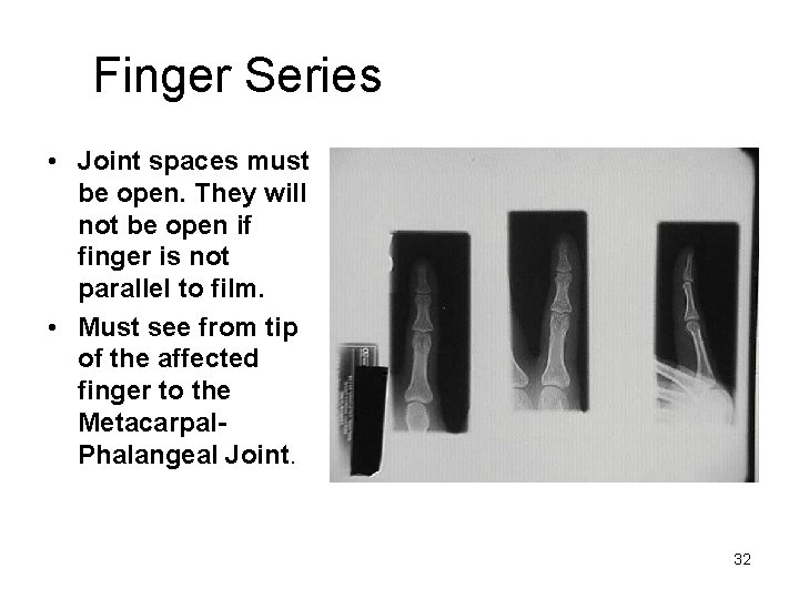 Finger Series • Joint spaces must be open. They will not be open if