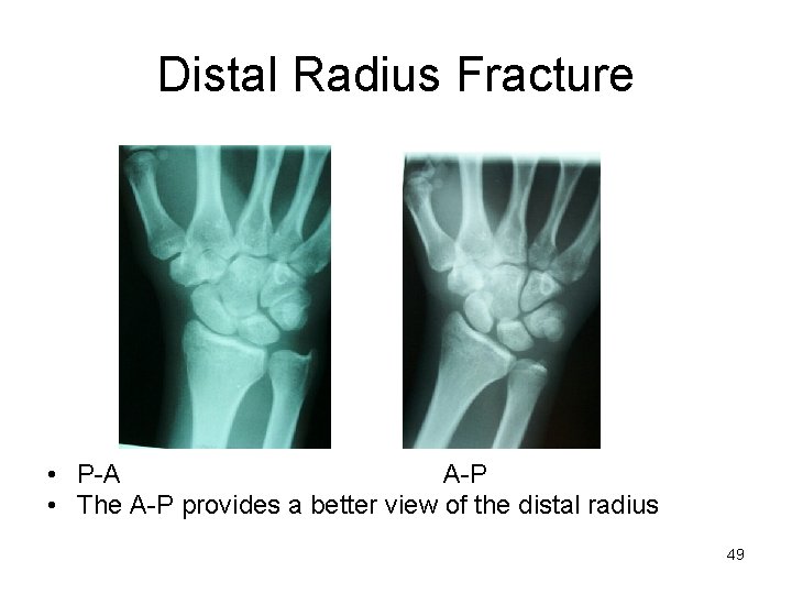 Distal Radius Fracture • P-A A-P • The A-P provides a better view of