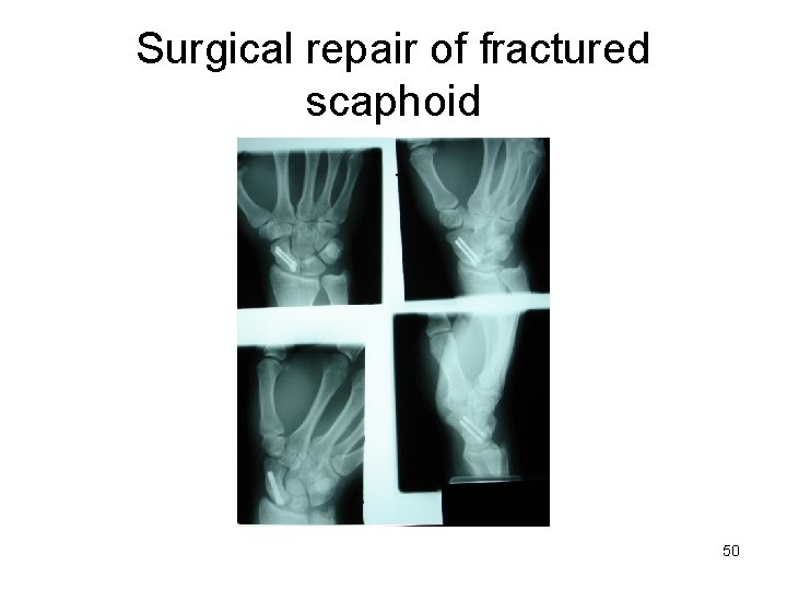 Surgical repair of fractured scaphoid 50 