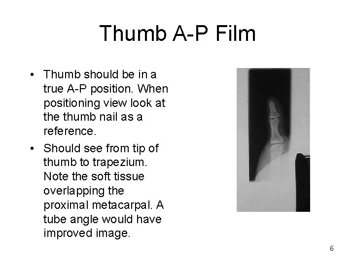 Thumb A-P Film • Thumb should be in a true A-P position. When positioning