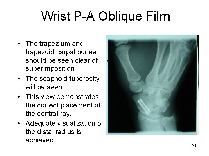 Wrist P-A Oblique Film • The trapezium and trapezoid carpal bones should be seen