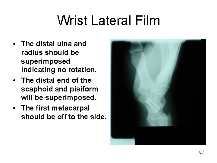 Wrist Lateral Film • The distal ulna and radius should be superimposed indicating no