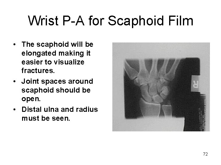 Wrist P-A for Scaphoid Film • The scaphoid will be elongated making it easier