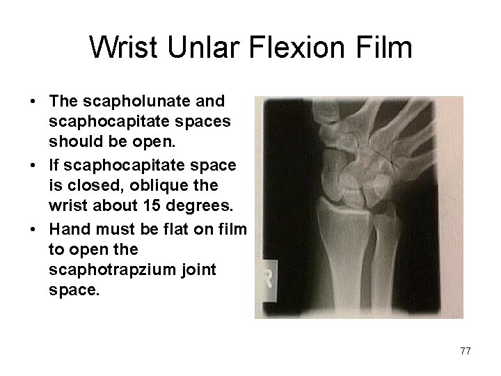 Wrist Unlar Flexion Film • The scapholunate and scaphocapitate spaces should be open. •