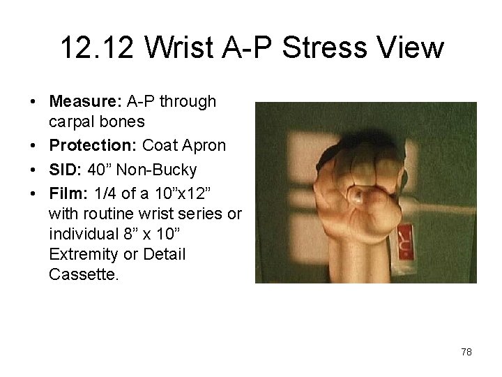 12. 12 Wrist A-P Stress View • Measure: A-P through carpal bones • Protection: