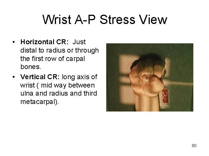 Wrist A-P Stress View • Horizontal CR: Just distal to radius or through the