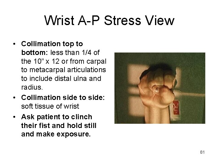 Wrist A-P Stress View • Collimation top to bottom: less than 1/4 of the