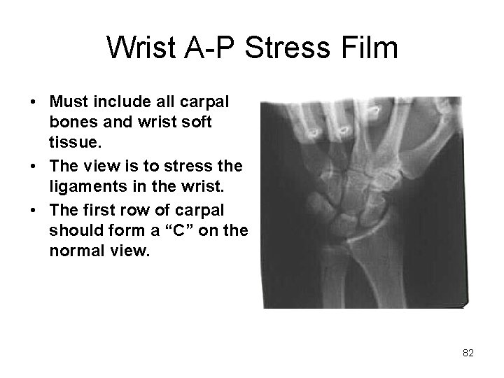 Wrist A-P Stress Film • Must include all carpal bones and wrist soft tissue.