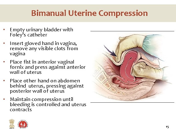 Bimanual Uterine Compression • Empty urinary bladder with Foley’s catheter • Insert gloved hand Bimanual Uterine Compression • Empty urinary bladder with Foley’s catheter • Insert gloved hand