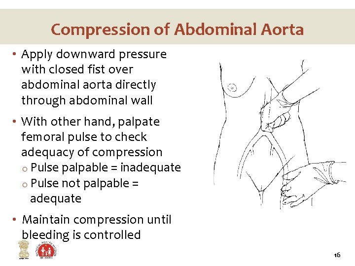 Compression of Abdominal Aorta • Apply downward pressure with closed fist over abdominal aorta