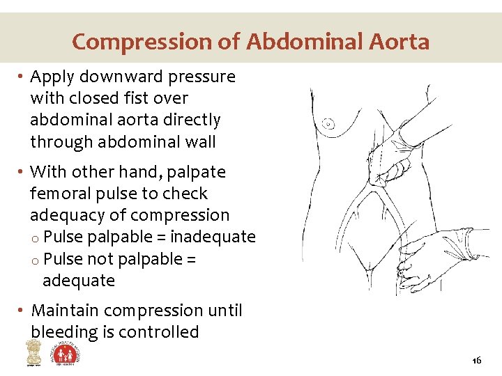 Compression of Abdominal Aorta • Apply downward pressure with closed fist over abdominal aorta Compression of Abdominal Aorta • Apply downward pressure with closed fist over abdominal aorta