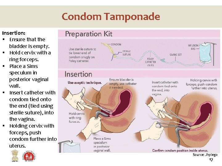Condom Tamponade Insertion: § Ensure that the bladder is empty. § Hold cervix with Condom Tamponade Insertion: § Ensure that the bladder is empty. § Hold cervix with