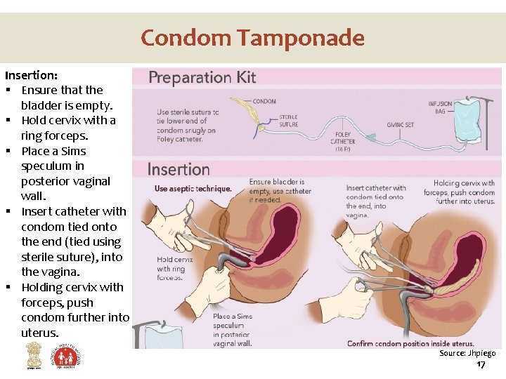 Condom Tamponade Insertion: § Ensure that the bladder is empty. § Hold cervix with