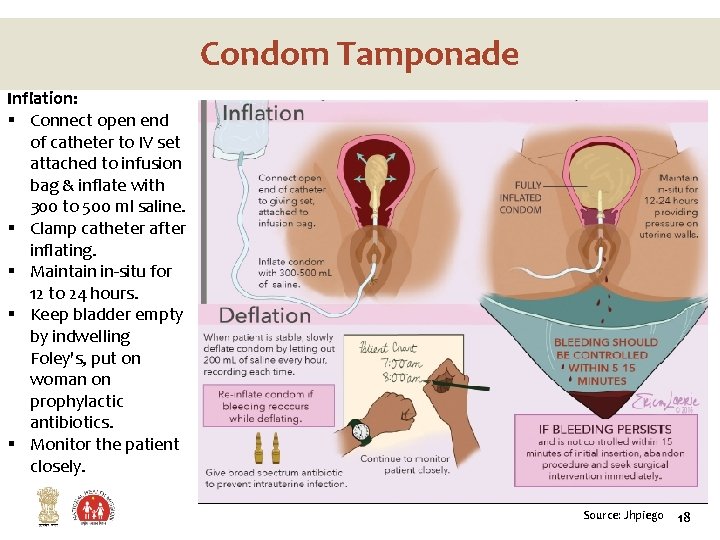 Condom Tamponade Inflation: § Connect open end of catheter to IV set attached to