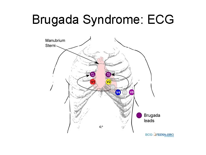 Brugada Syndrome: ECG 