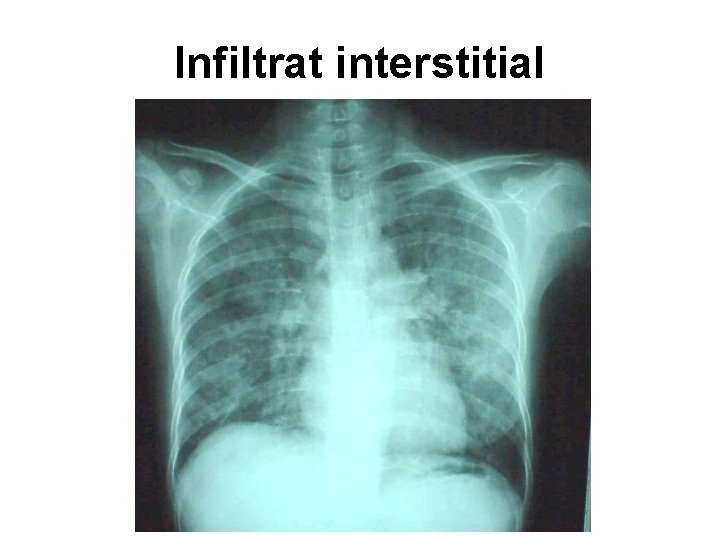 Infiltrat interstitial 