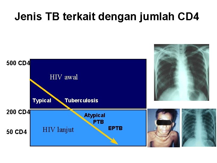 Jenis TB terkait dengan jumlah CD 4 500 CD 4 HIV awal Typical Tuberculosis