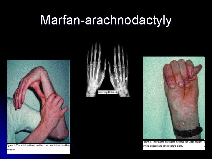 Marfan-arachnodactyly 