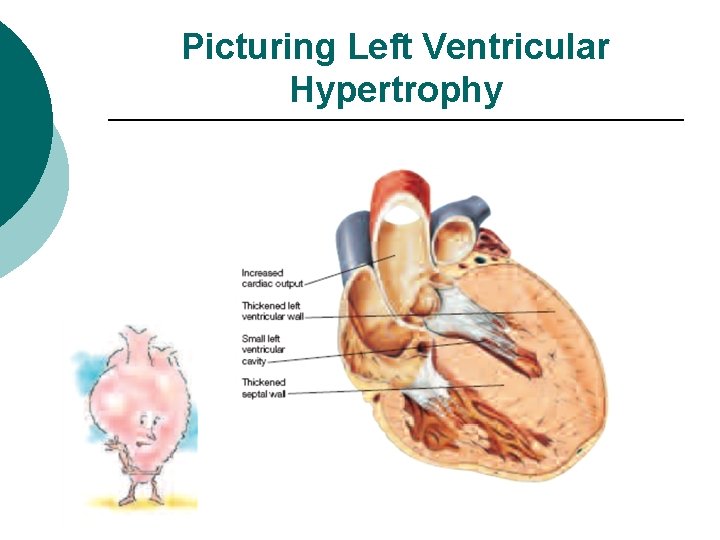 Picturing Left Ventricular Hypertrophy 